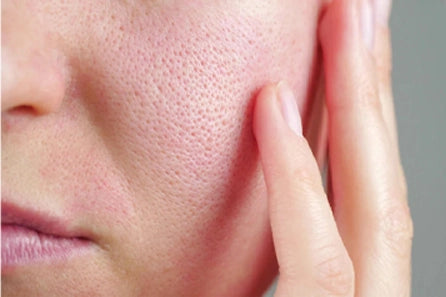 Open Pores