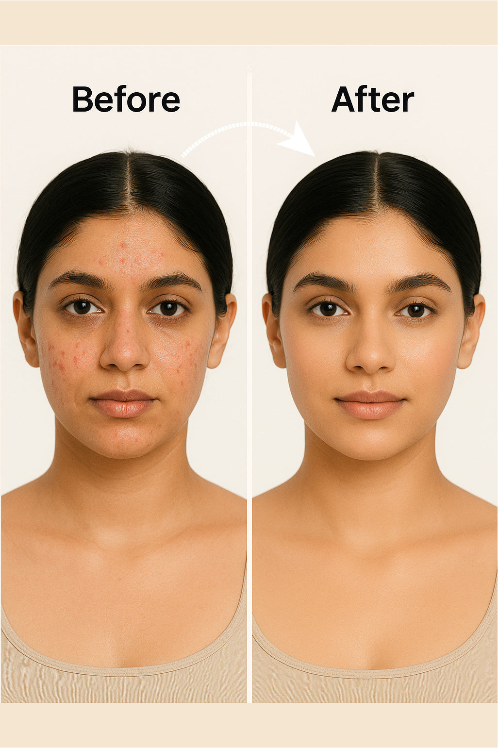 2% SALICYLIC ACID : FACE SERUM FOR ANTI - ACNE