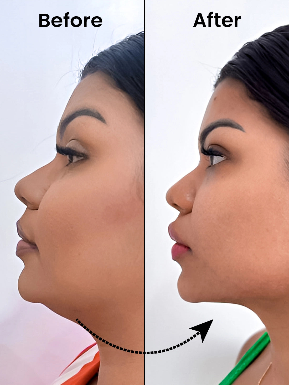 CHIN UP FACIAL CELLULITE REDUCTION ( 4 WEEKS )